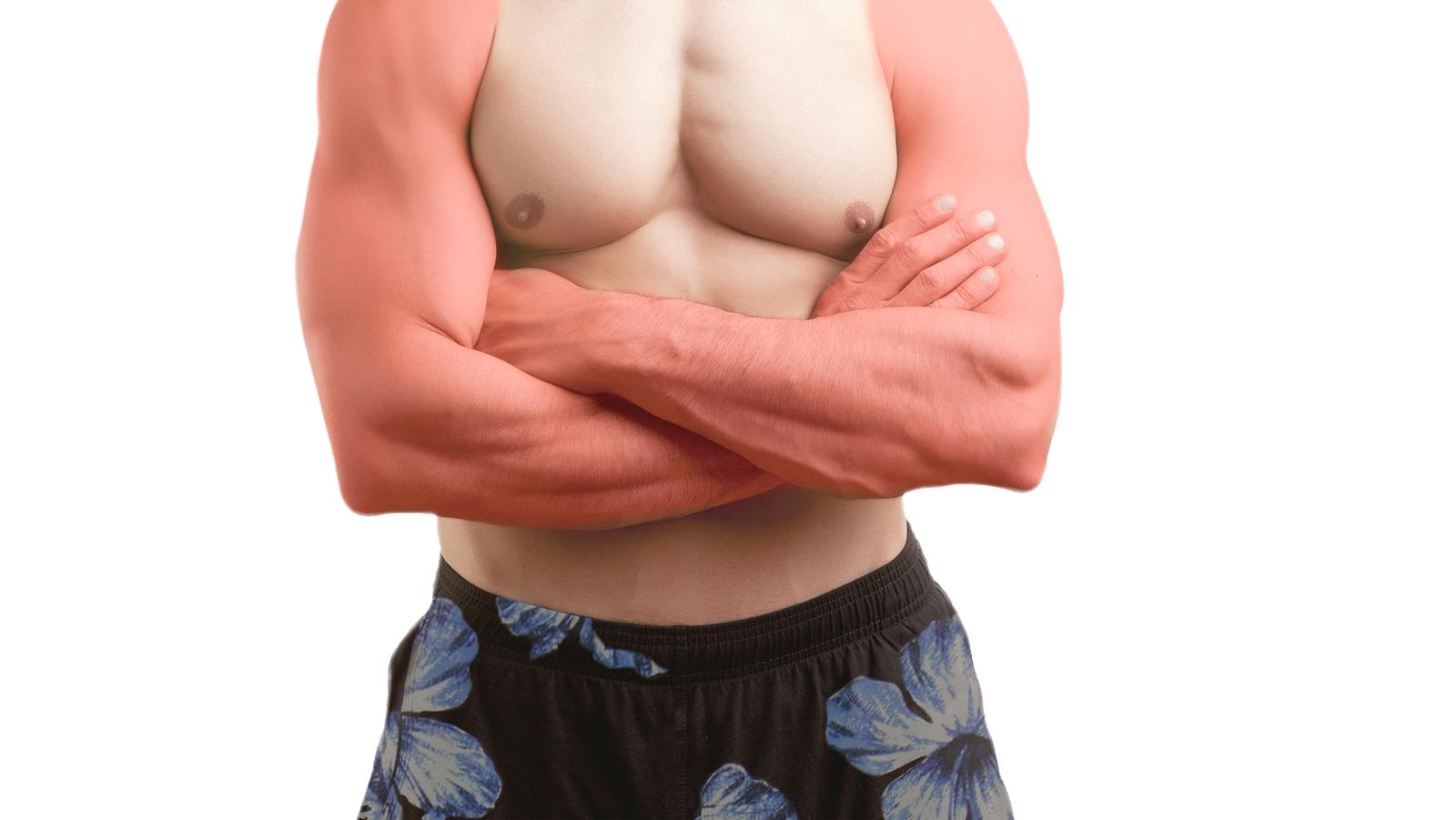 spálenie sa slnkom Spálenie sa slnkom môžeme liečiť podomácky