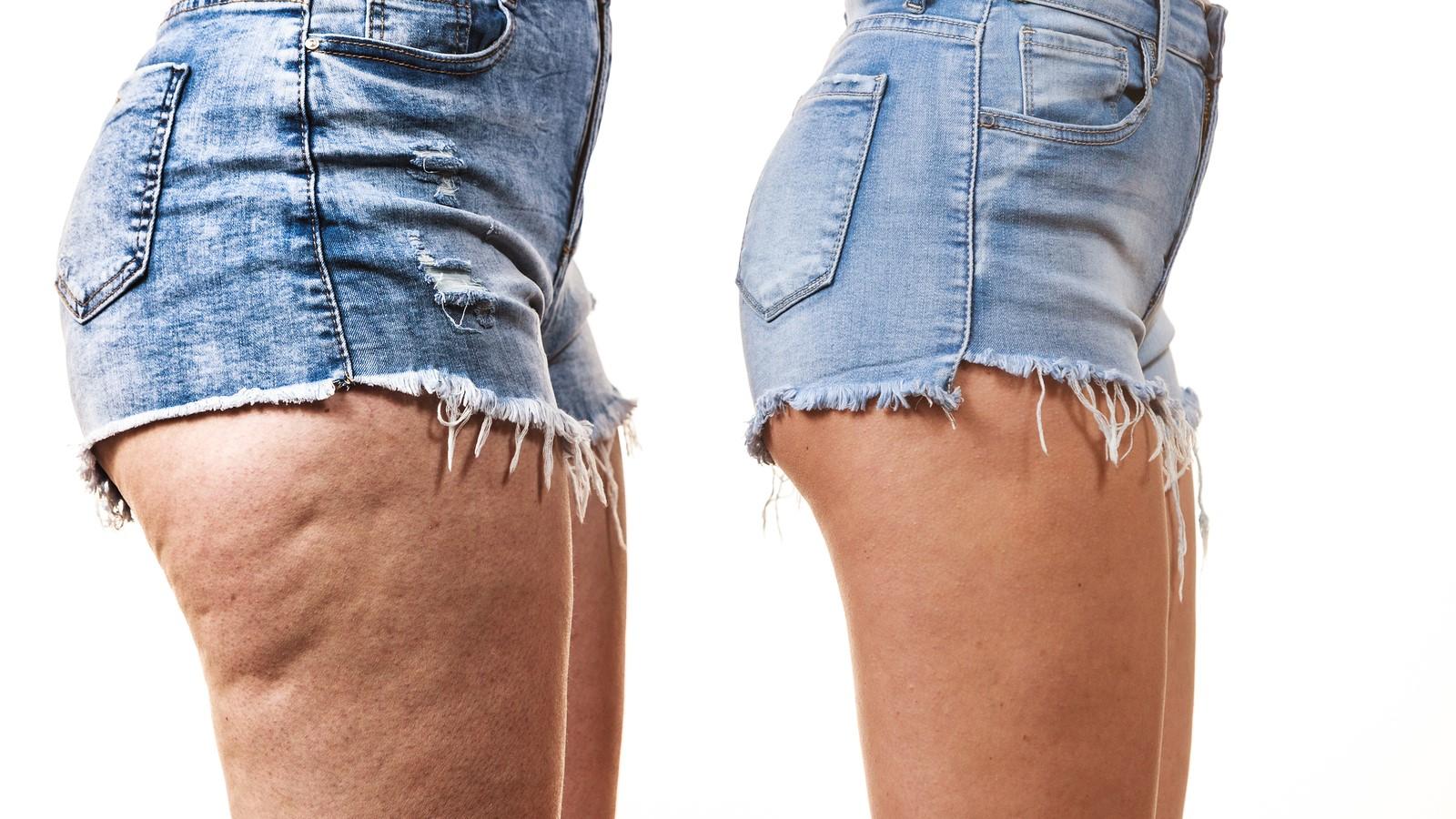 Strie a celulitída - postačí správne ošetrenie