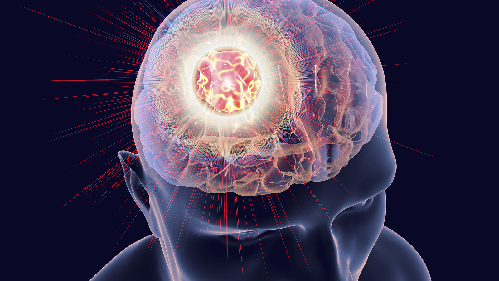Злокачественное новообразование мозга. Bosh Miya saratoni. Метастазы в головном мозге. Злокачественная опухоль головного мозга.